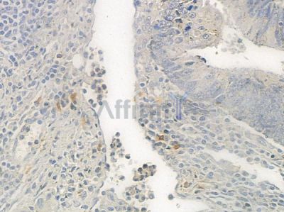 ZNF592 Antibody - DF4629 at 1/100 staining human colon carcinoma by IHC-P.