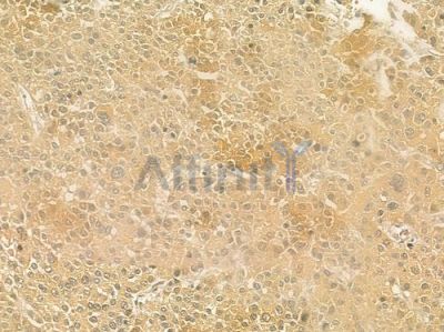 Cytochrome P450 4V2 Antibody - DF4744 at 1/100 staining human hepatocellular carcinoma by IHC-P.