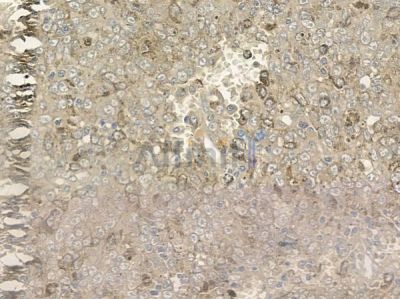 Cytochrome P450 2A6V2 Antibody - DF4754 at 1/100 staining human melanoma by IHC-P.