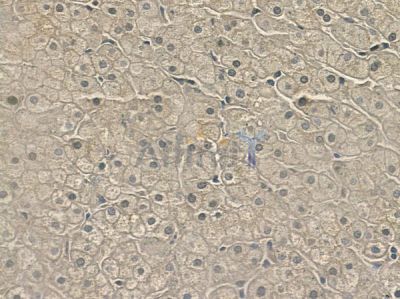 Cytochrome P450 2A7 Antibody - DF4755 at 1/100 staining human cervical carcinoma by IHC-P.