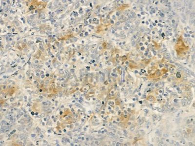 Cytochrome P450 8B1 Antibody - DF4762 at 1/100 staining human thymoma by IHC-P.