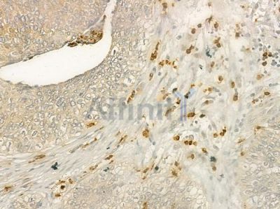 MATK Antibody - DF4775 at 1/100 staining human cervical carcinoma by IHC-P.