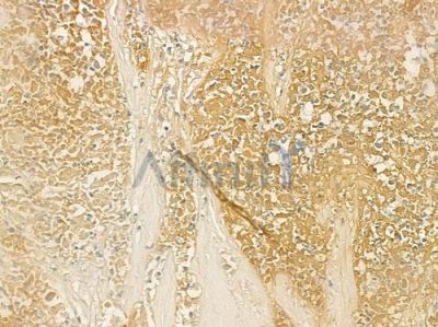 FGB Antibody - DF4830 at 1/100 staining human breast carcinoma by IHC-P.