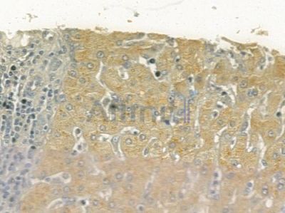 PTGER3 Antibody - DF4879 at 1/100 staining human hepatocellular carcinoma by IHC-P.
