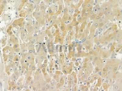 GPR158 Antibody - DF4957 at 1/100 staining human hepatocellular carcinoma by IHC-P.