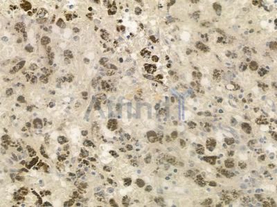 IKK epsilon Antibody - DF6047 at 1/100 staining human melanoma by IHC-P.