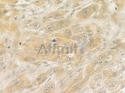 MDK Antibody - DF6054 at 1/100 staining human tongue carcinoma by IHC-P.