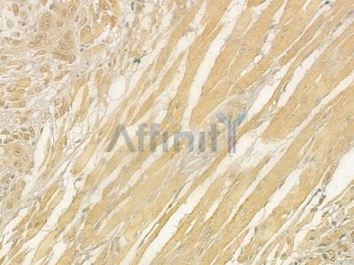 TUBA4A  Antibody - DF6081 at 1/100 staining human tongue carcinoma by IHC-P.