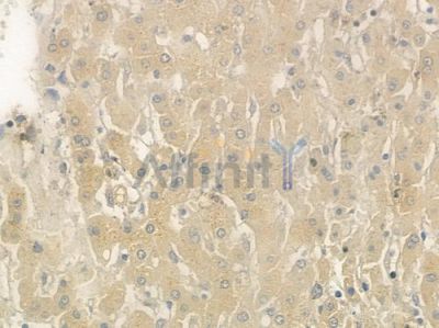 TGF alpha Antibody - DF6099 at 1/100 staining human hepatocellular carcinoma by IHC-P.