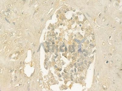 EEF1A1 Antibody - DF6156 at 1/100 staining human prostate carcinoma by IHC-P.