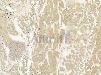 NEK8 Antibody - DF6166 at 1/100 staining human lung adenocarcinoma by IHC-P.