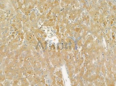 Carbonic Anhydrase 1/CA1 Antibody - DF6190 at 1/100 staining human hepatocellular carcinoma by IHC-P.