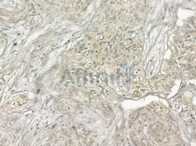 U2AF1 Antibody - DF6195 at 1/100 staining human cervical carcinoma by IHC-P.