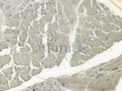 DEFB132 Antibody - DF6219 at 1/100 staining human tongue carcinoma by IHC-P.