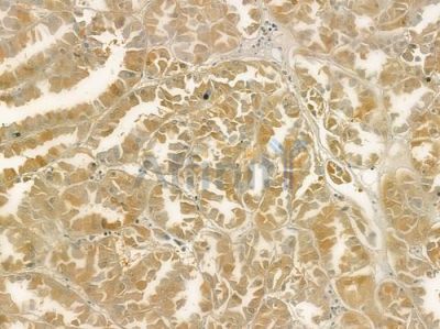 GPX5 Antibody - DF6220 at 1/100 staining human renal cell carcinoma by IHC-P.