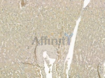 NTF4 Antibody - DF6226 at 1/100 staining human hepatocellular carcinoma by IHC-P.