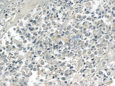 AMBRA1 Antibody - DF6228 at 1/100 staining human prostate carcinoma by IHC-P.