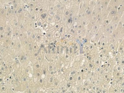 RNASE11 Antibody - DF6234 at 1/100 staining human gastric carcinoma by IHC-P.