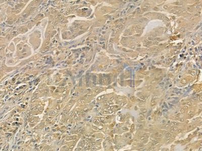 TYMP Antibody - DF6237 at 1/100 staining human lung adenocarcinoma by IHC-P.