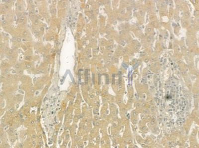 SPINK1 Antibody - DF6239 at 1/100 staining human hepatocellular carcinoma by IHC-P.