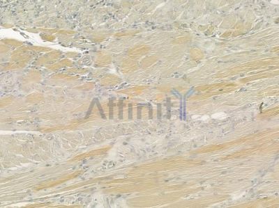 ATP2A2 Antibody - DF6240 at 1/100 staining human tongue carcinoma by IHC-P.