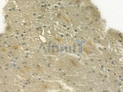 GLP1 Antibody - DF6255 at 1/100 staining human astrocytoma by IHC-P.