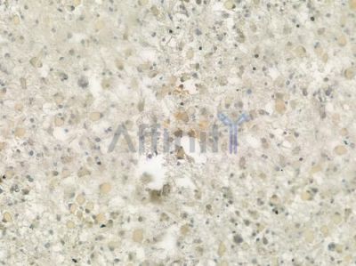 GLP1 Antibody - DF6255 at 1/100 staining human thyroid carcinoma by IHC-P.