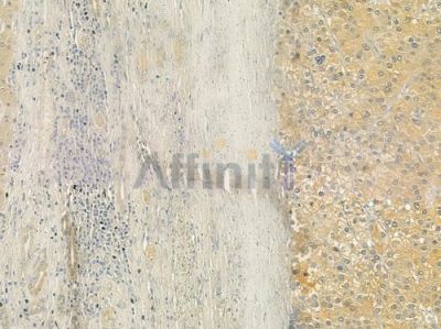ATG4C Antibody - DF6259 at 1/100 staining human hepatocellular carcinoma by IHC-P.