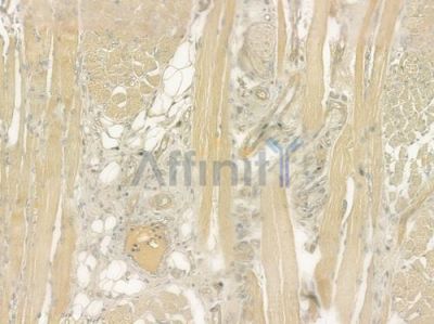 ATG4C Antibody - DF6259 at 1/100 staining human tongue carcinoma by IHC-P.