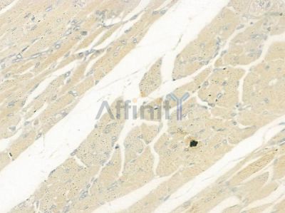 PHPT1 Antibody - DF6262 at 1/100 staining human tongue carcinoma by IHC-P.