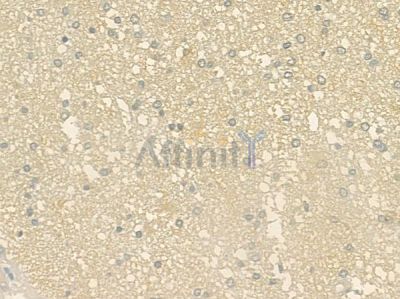 PHPT1 Antibody - DF6262 at 1/100 staining human glioblastoma by IHC-P.