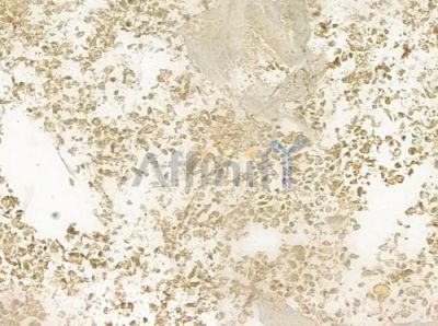 TCF4 Antibody - DF6275 at 1/100 staining human breast carcinoma by IHC-P.