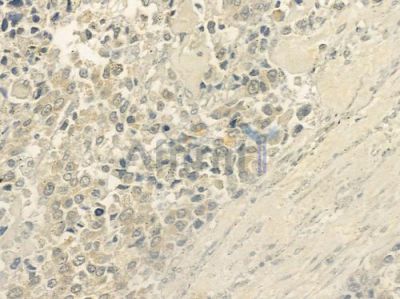 SH2D1A Antibody - DF6277 at 1/100 staining human prostate carcinoma by IHC-P.