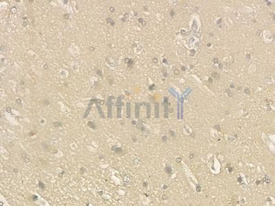 NEUROD1 Antibody - DF6281 at 1/100 staining human glioblastoma by IHC-P.