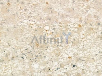 TICAM1 Antibody - DF6289 at 1/100 staining human astrocytoma by IHC-P.