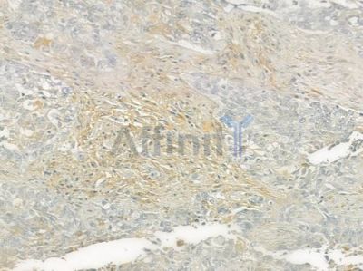 BCL2L2 Antibody - DF6292 at 1/100 staining human lung squamous cell carcinoma by IHC-P.