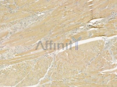 alpha-Actinin Antibody - DF6294 at 1/100 staining human tongue carcinoma by IHC-P.