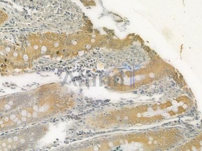 Calmodulin1/2/3 Antibody - DF6295 at 1/100 staining human colon carcinoma by IHC-P.