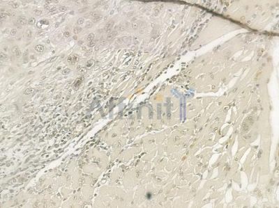 Rel Antibody - DF6315 at 1/100 staining human tongue carcinoma by IHC-P.