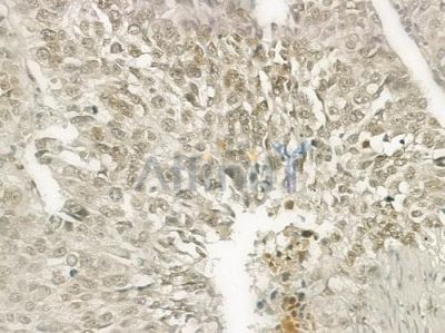 Rel Antibody - DF6315 at 1/100 staining human lung squamous cell carcinoma by IHC-P.