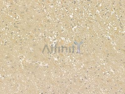 GGA2 Antibody - DF6320 at 1/100 staining human pituitary adenoma by IHC-P.