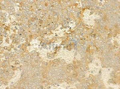 KRAS Antibody - DF6324 at 1/100 staining human melanoma by IHC-P.