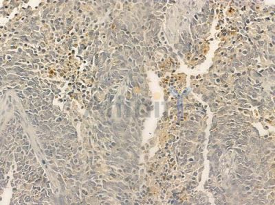 CD86 Antibody - DF6332 at 1/100 staining human large cell lung carcinoma by IHC-P.