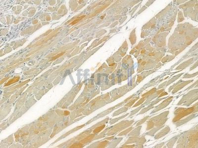 CA3 Antibody - DF6344 at 1/100 staining human tongue carcinoma by IHC-P.