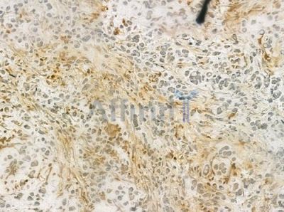 NET1 Antibody - DF6345 at 1/100 staining human gastric carcinoma by IHC-P.