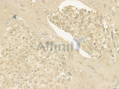 APOH Antibody - DF6352 at 1/100 staining human prostate carcinoma by IHC-P.