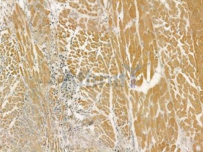 GIPC2 Antibody - DF6357 at 1/100 staining human tongue carcinoma by IHC-P.