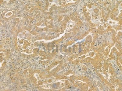 GIPC2 Antibody - DF6357 at 1/100 staining human lung adenocarcinoma by IHC-P.