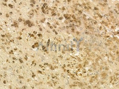 AMPK alpha Antibody - DF6361 at 1/100 staining human melanoma by IHC-P.
