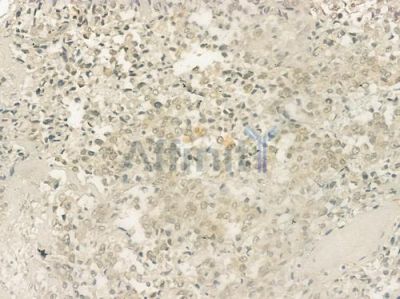 AMPK alpha Antibody - DF6361 at 1/100 staining human prostate carcinoma by IHC-P.
